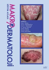 Makro Dermatoloji Eğitim Atlası - Yalçın Tüzün, Server Serdaroğlu