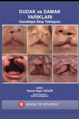 Dudak ve Damak Yarıkları Hacettepe Ekip Yaklaşımı
