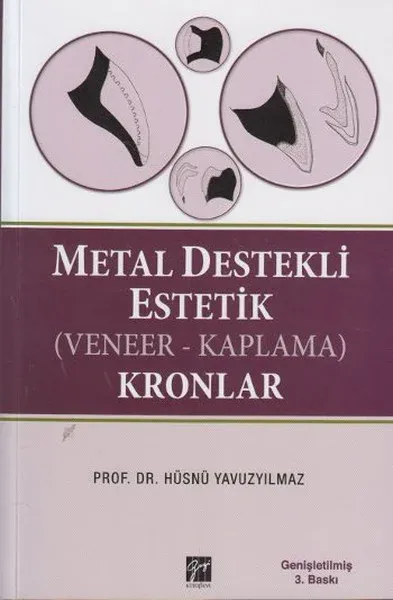Metal Destekli Estetik (Veneer-Kaplama)Kronlar (Ciltli)