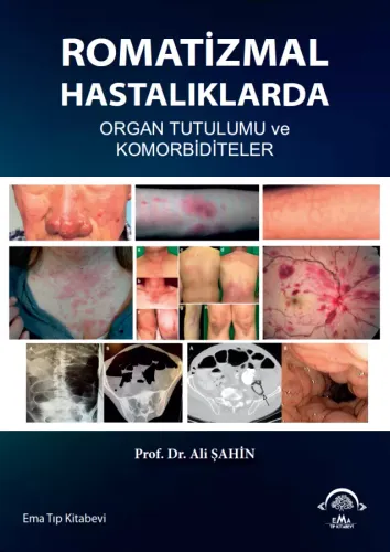 Romatizmal Hastalıklarda Organ Tutulumu ve Komorbiditeler
