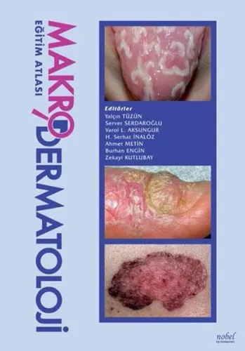 Makro Dermatoloji Eğitim Atlası - Yalçın Tüzün, Server Serdaroğlu