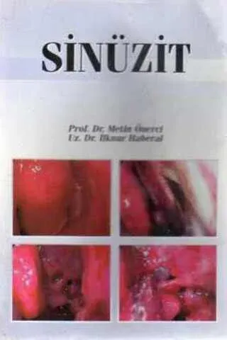 Sinüzit
